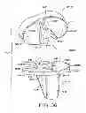 Fig. 23 - Tibial prosthesis