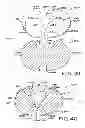 Fig. 25 - Tibial prosthesis