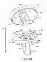 Fig. 26 - Tibial prosthesis