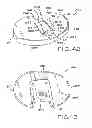 Fig. 27 - Tibial prosthesis