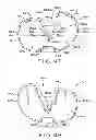 Fig. 30 - Tibial prosthesis