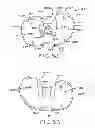 Fig. 33 - Tibial prosthesis