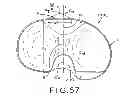 Fig. 36 - Tibial prosthesis