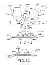 Fig. 04 - Provisional tibial prosthesis system