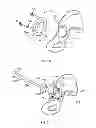 Fig. 03 - Patient-specific hip joint devices