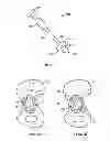Fig. 04 - Patient-specific hip joint devices