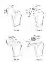 Fig. 12 - Patient-specific hip joint devices