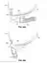 Fig. 83 - Patient interface systems