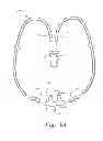 Fig. 03 - VENTILATION INTERFACE FOR SLEEP APNEA THERAPY