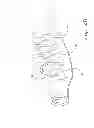 Fig. 04 - VENTILATION INTERFACE FOR SLEEP APNEA THERAPY