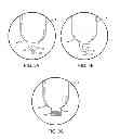 Fig. 03 - CONTAINER WITH END FEATURE AND METHOD OF MAKING SAME