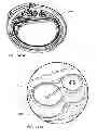 Fig. 165 - Infusion pump assembly