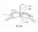 Fig. 236 - Infusion pump assembly
