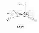 Fig. 237 - Infusion pump assembly