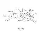 Fig. 240 - Infusion pump assembly