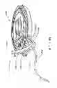 Fig. 260 - Infusion pump assembly