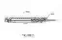 Fig. 300 - Infusion pump assembly