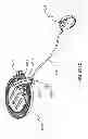 Fig. 303 - Infusion pump assembly