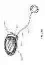 Fig. 304 - Infusion pump assembly