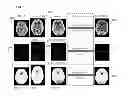 Fig. 03 - Method and system for multi-atlas segmentation of brain computed tomography image data