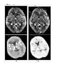 Fig. 04 - Method and system for multi-atlas segmentation of brain computed tomography image data