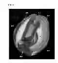 Fig. 05 - Method and system for multi-atlas segmentation of brain computed tomography image data