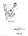 Fig. 03 - Particulate implants and biodegradable fiducial markers