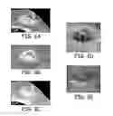 Fig. 04 - Particulate implants and biodegradable fiducial markers