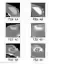 Fig. 05 - Particulate implants and biodegradable fiducial markers