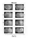Fig. 69 - Methods for Treating Conditions Associated with MASP-2 Dependent Complement Activation