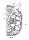 Fig. 32 - Surgical access system and related methods
