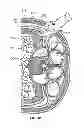 Fig. 33 - Surgical access system and related methods