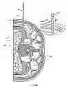 Fig. 40 - Surgical access system and related methods