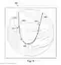 Fig. 06 - Device for anatomical lesion length estimation
