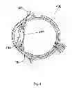 Fig. 05 - Method for the treatment of cataract