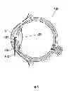 Fig. 07 - Method for the treatment of cataract