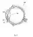 Fig. 08 - Method for the treatment of cataract