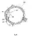 Fig. 09 - Method for the treatment of cataract