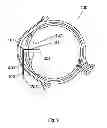 Fig. 10 - Method for the treatment of cataract