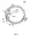 Fig. 11 - Method for the treatment of cataract