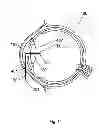 Fig. 12 - Method for the treatment of cataract