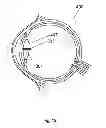 Fig. 13 - Method for the treatment of cataract