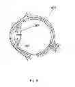Fig. 14 - Method for the treatment of cataract