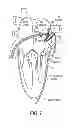 Fig. 09 - Methods and systems for accessing a pericardial space and preventing strokes arising from the left atrial appendage