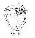 Fig. 06 - HIGH RESOLUTION MAP AND ABLATE CATHETER