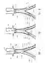 Fig. 07 - Endoluminal prosthesis and delivery device