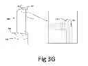 Fig. 07 - Variable depth surgical fixation