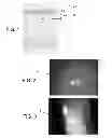 Fig. 02 - Microfabricated instruments and methods to treat recurrent corneal erosions