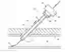 Fig. 01 - Collapsible sheath and tapered dilator for tissue puncture access