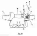Fig. 22 - Spinal facet implants with mating articulating bearing surface and methods of use